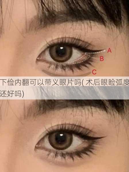 下俭内翻可以带义眼片吗( 术后眼睑弧度还好吗)