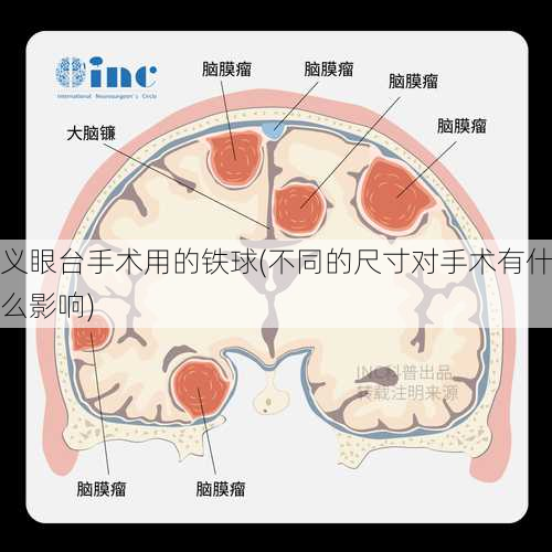 义眼台手术用的铁球(不同的尺寸对手术有什么影响)