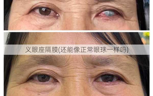 义眼座隔膜(还能像正常眼球一样吗)
