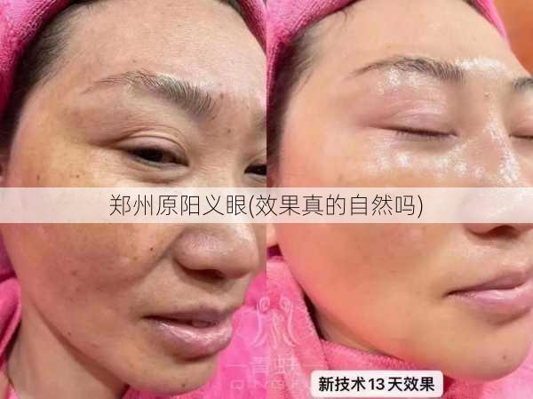 郑州原阳义眼(效果真的自然吗)