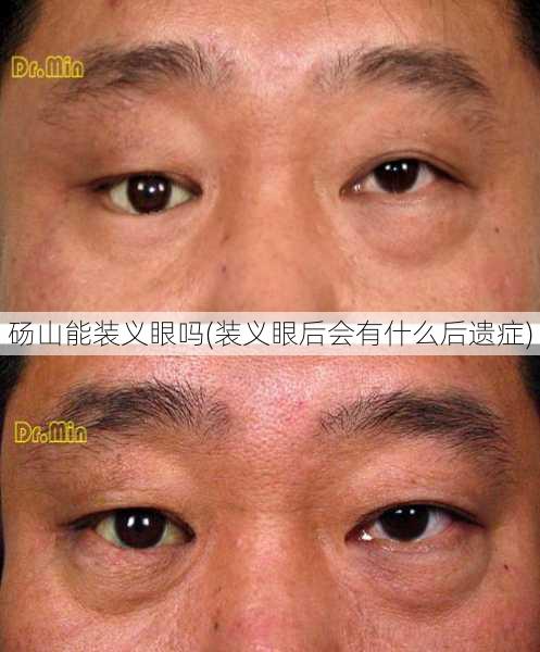 砀山能装义眼吗(装义眼后会有什么后遗症)