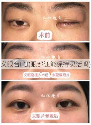 义眼台FCI(眼部还能保持灵活吗)