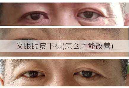 义眼眼皮下榻(怎么才能改善)