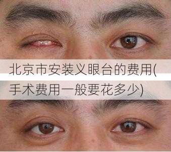 北京市安装义眼台的费用(  手术费用一般要花多少)