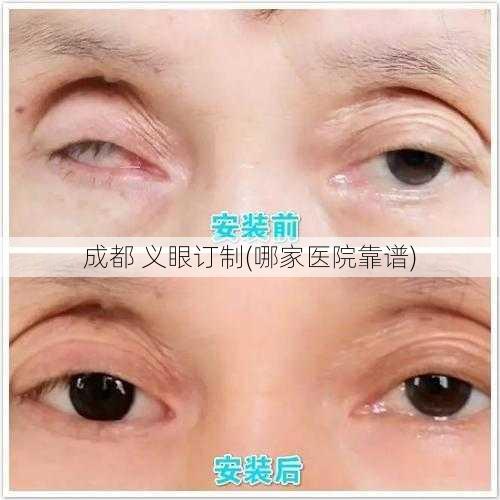 成都 义眼订制(哪家医院靠谱)