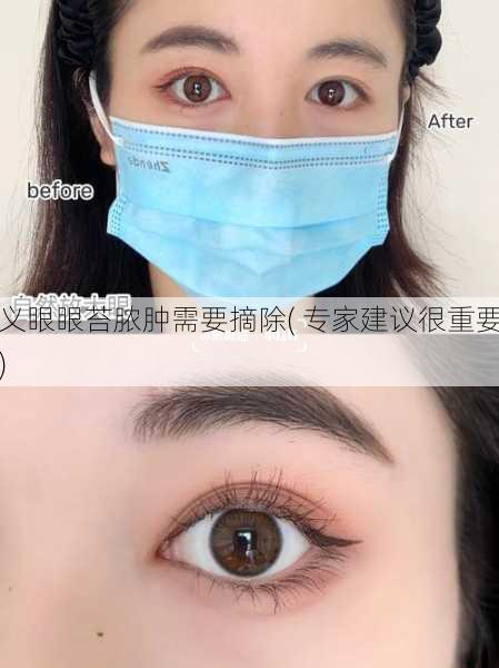 义眼眼苔脓肿需要摘除( 专家建议很重要)