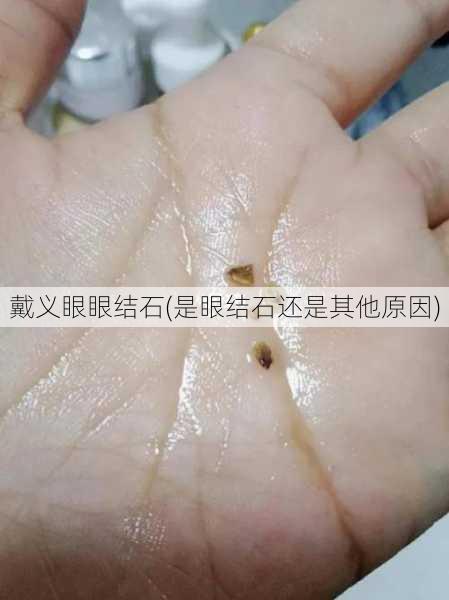 戴义眼眼结石(是眼结石还是其他原因)
