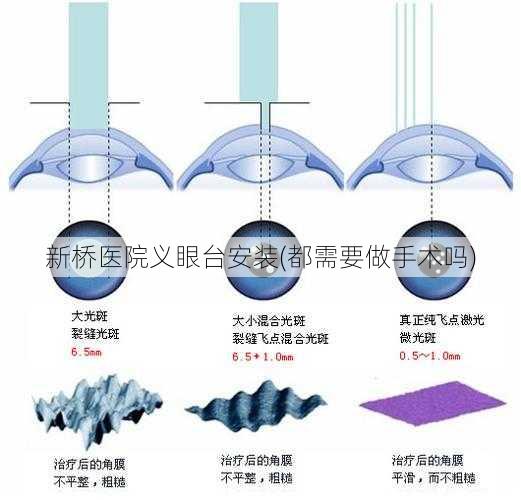 新桥医院义眼台安装(都需要做手术吗)