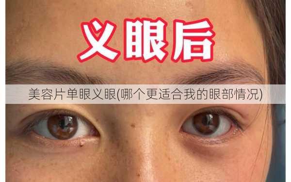 美容片单眼义眼(哪个更适合我的眼部情况)