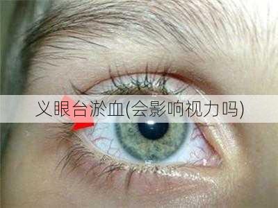 义眼台淤血(会影响视力吗)