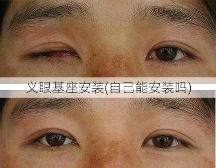 义眼基座安装(自己能安装吗)