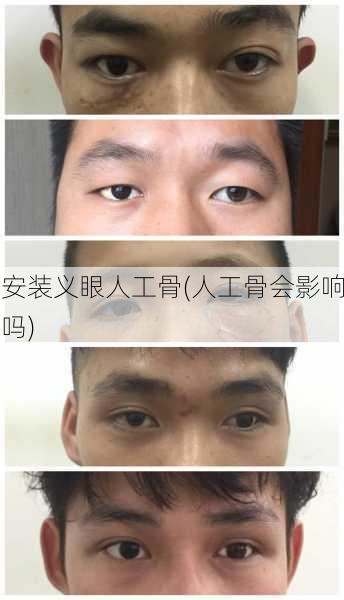 安装义眼人工骨(人工骨会影响吗)