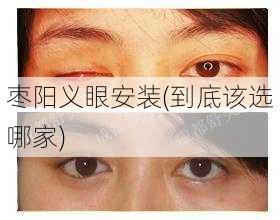 枣阳义眼安装(到底该选哪家)