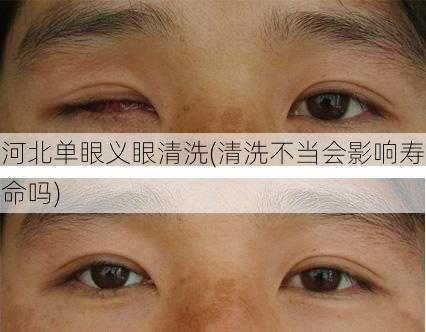 河北单眼义眼清洗(清洗不当会影响寿命吗)