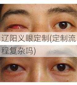 辽阳义眼定制(定制流程复杂吗)