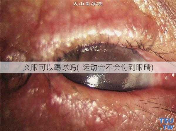 义眼可以踢球吗(  运动会不会伤到眼睛)