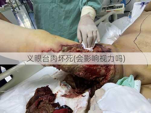 义眼台肉坏死(会影响视力吗)