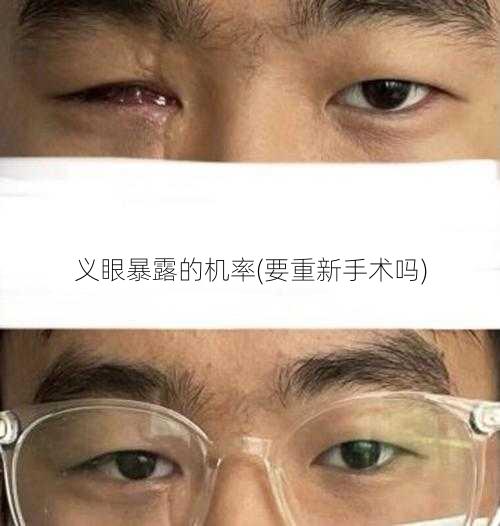 义眼暴露的机率(要重新手术吗)