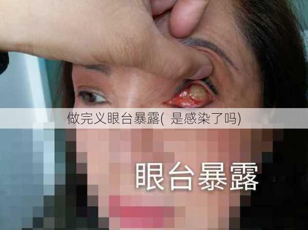 做完义眼台暴露(  是感染了吗)