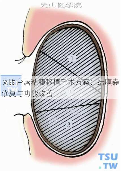 义眼台唇粘膜移植手术方案：结膜囊修复与功能改善