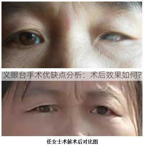 义眼台手术优缺点分析：术后效果如何？