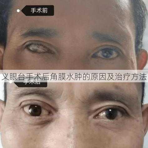 义眼台手术后角膜水肿的原因及治疗方法