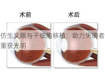 仿生义眼与干细胞移植：助力失明者重获光明