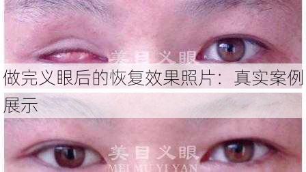 做完义眼后的恢复效果照片：真实案例展示