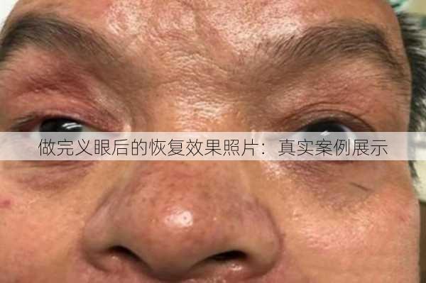 做完义眼后的恢复效果照片：真实案例展示