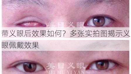 带义眼后效果如何？多张实拍图揭示义眼佩戴效果