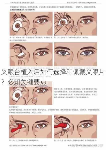 义眼台植入后如何选择和佩戴义眼片？必知关键要点