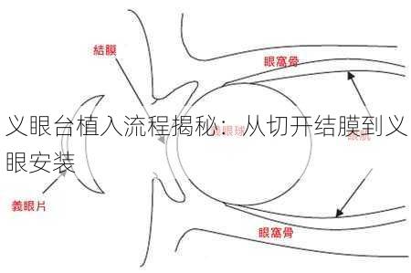 义眼台植入流程揭秘：从切开结膜到义眼安装