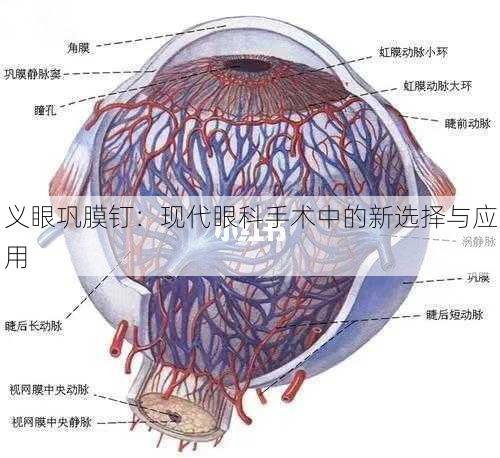 义眼巩膜钉：现代眼科手术中的新选择与应用