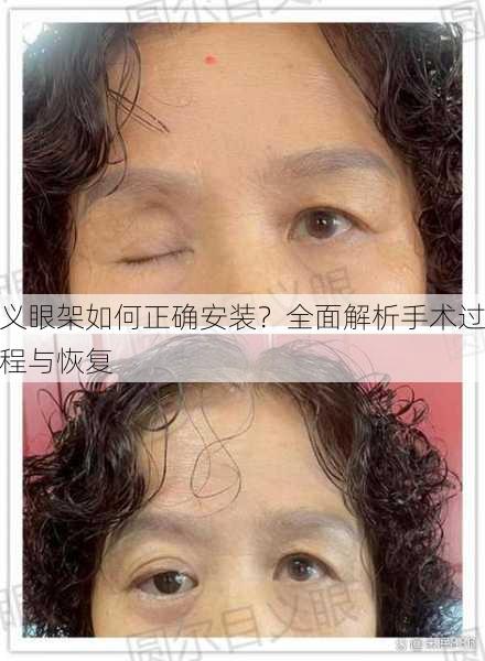 义眼架如何正确安装？全面解析手术过程与恢复