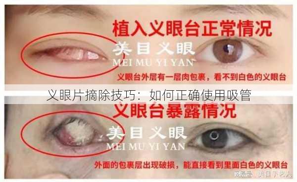 义眼片摘除技巧：如何正确使用吸管