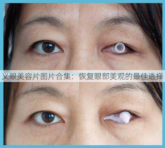 义眼美容片图片合集：恢复眼部美观的最佳选择