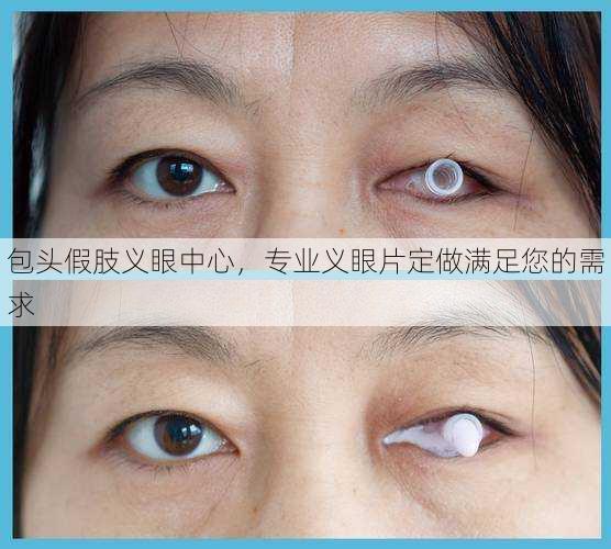 包头假肢义眼中心，专业义眼片定做满足您的需求