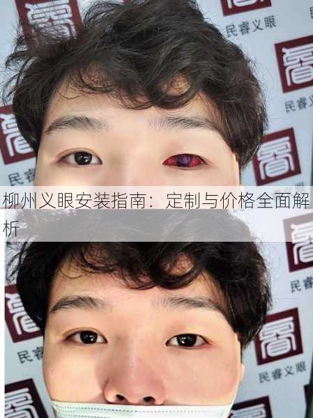 柳州义眼安装指南：定制与价格全面解析