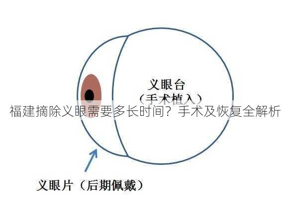 福建摘除义眼需要多长时间？手术及恢复全解析