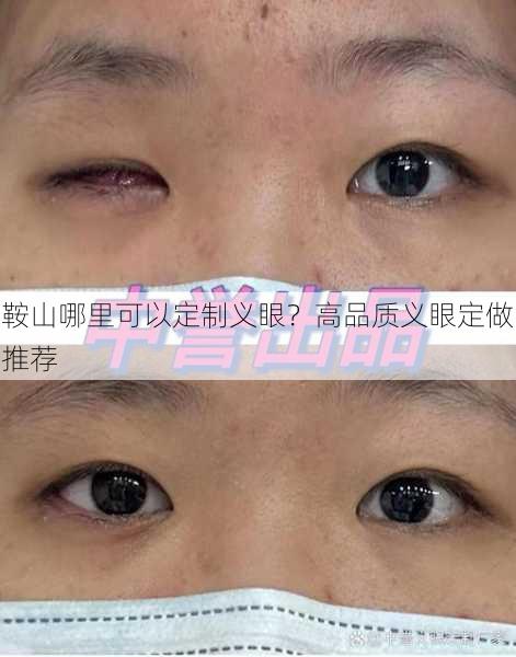 鞍山哪里可以定制义眼？高品质义眼定做推荐
