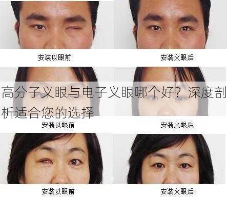 高分子义眼与电子义眼哪个好？深度剖析适合您的选择