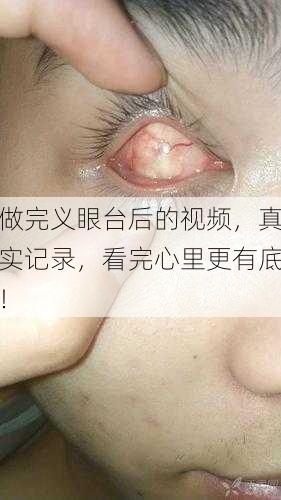 做完义眼台后的视频，真实记录，看完心里更有底！