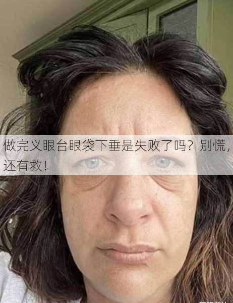 做完义眼台眼袋下垂是失败了吗？别慌，还有救！