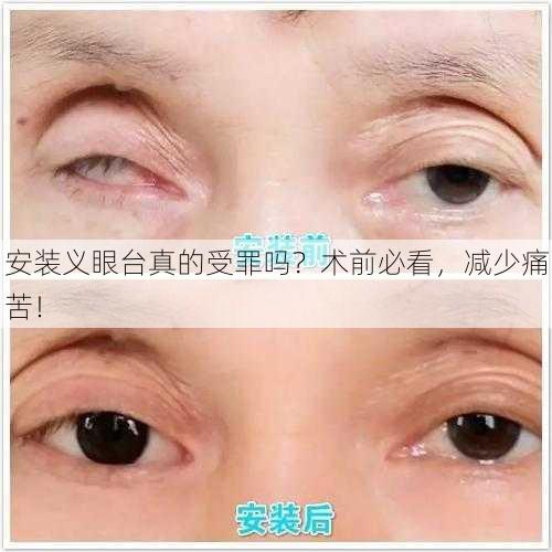安装义眼台真的受罪吗？术前必看，减少痛苦！