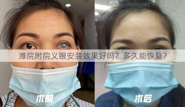 潍院附院义眼安装效果好吗？多久能恢复？