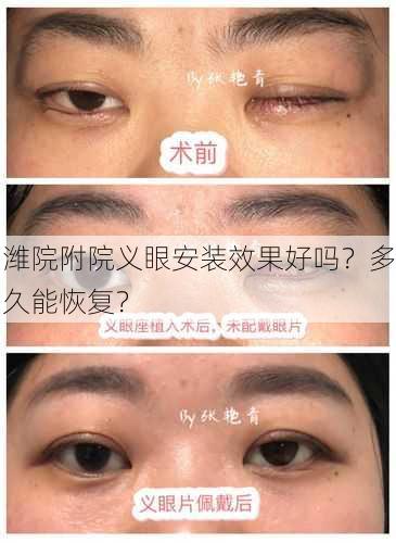 潍院附院义眼安装效果好吗？多久能恢复？