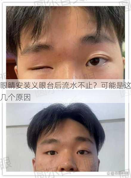 眼睛安装义眼台后流水不止？可能是这几个原因