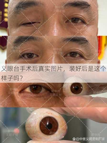 义眼台手术后真实图片，装好后是这个样子吗？