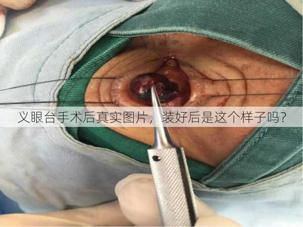 义眼台手术后真实图片，装好后是这个样子吗？