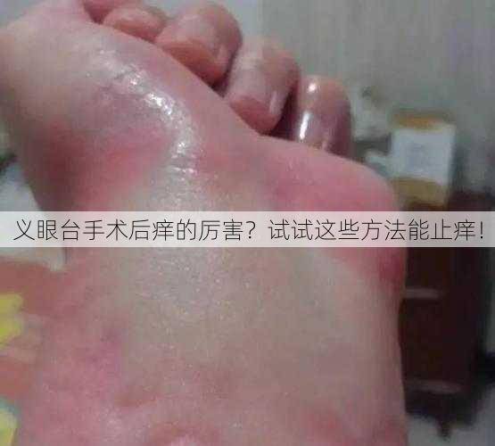 义眼台手术后痒的厉害？试试这些方法能止痒！